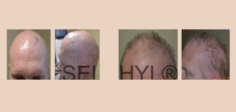 PRFM Hair Loss Before And After Gallery park slope